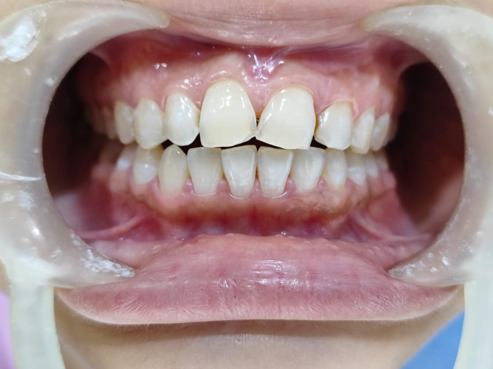 Teeth Whitening in Miyapur