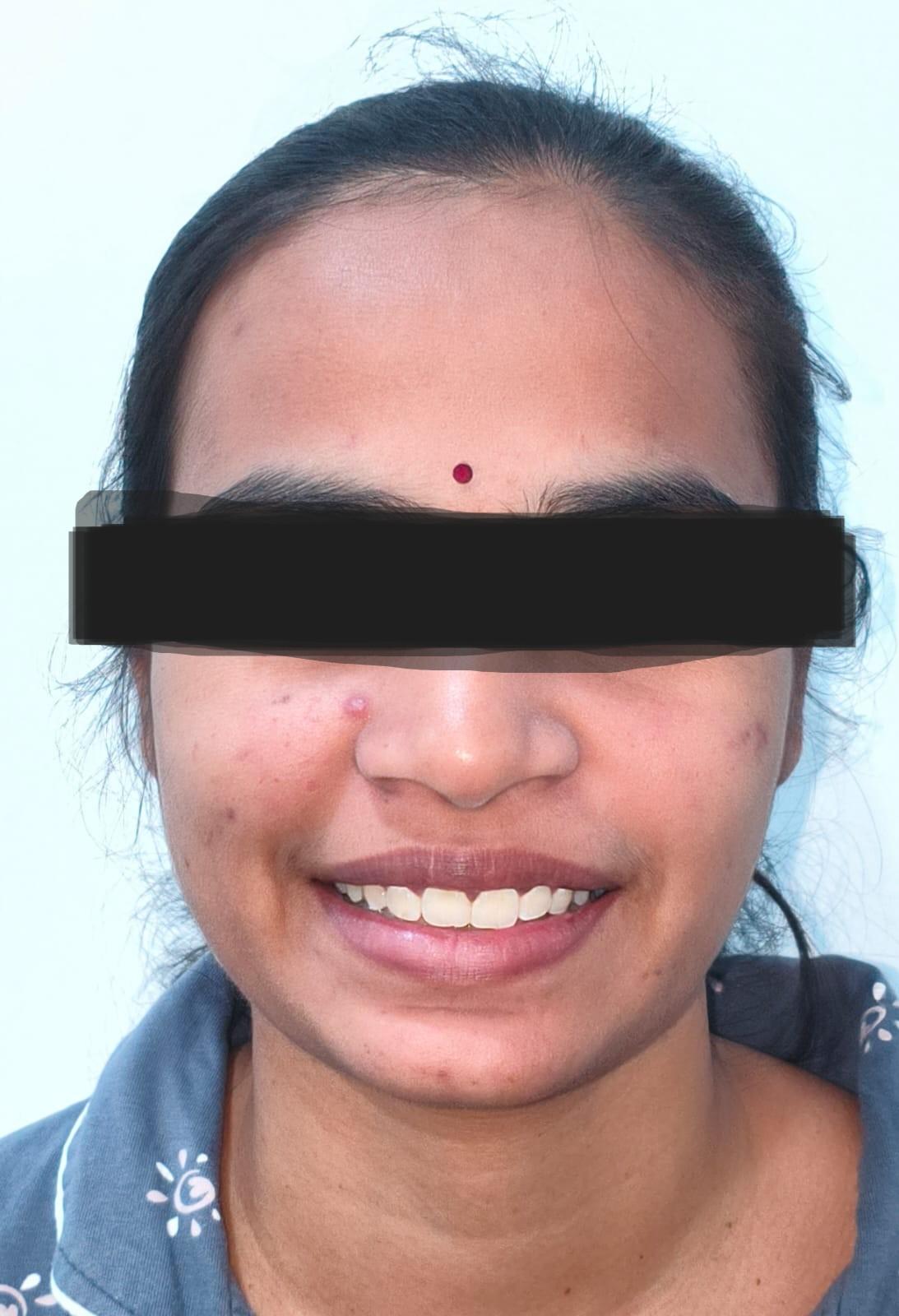 Smile Designing in Hafeezpet